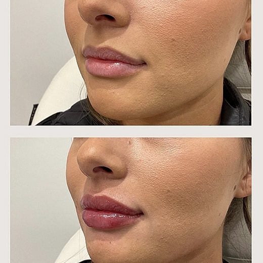 Lip enhancement before and after comparison photos.